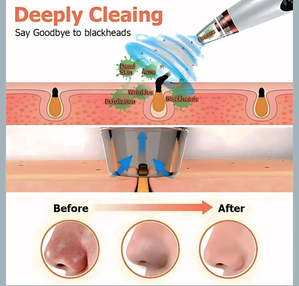 Portable Blackhead Remover™ | Deep Clean, Smooth Skin